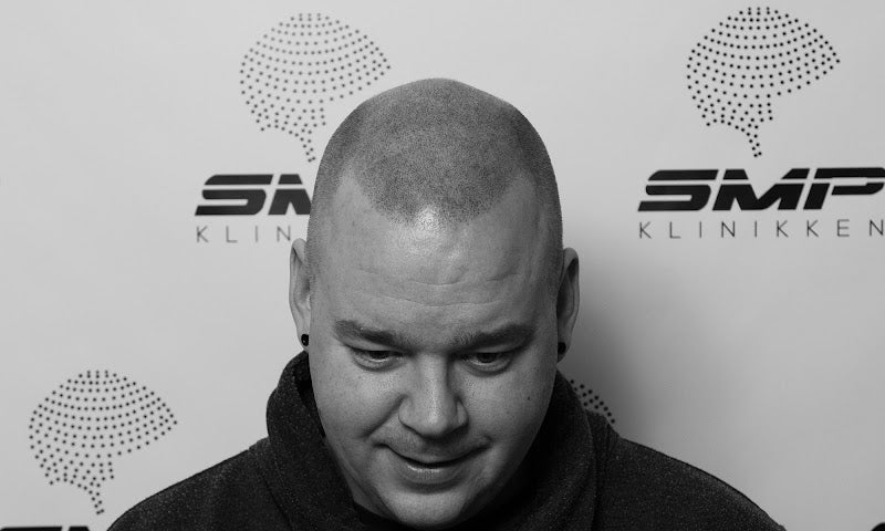 SMP Klinikken | Hair Transplant | 3120 Nøtterøy