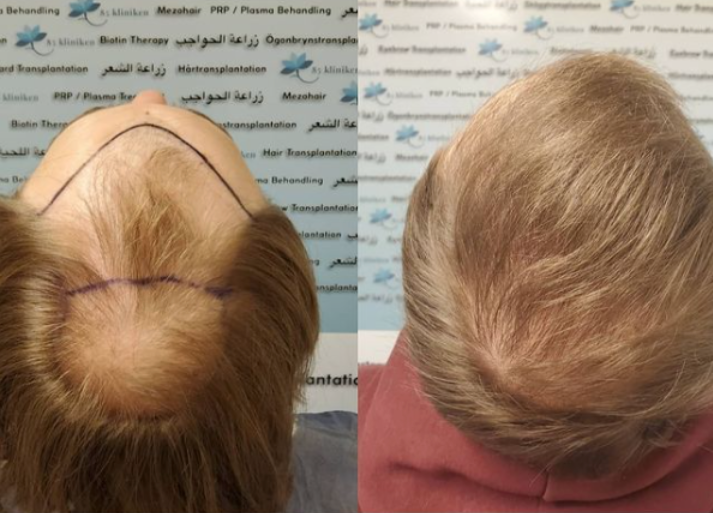 85Kliniken Stockholm (Hårtransplantation)(PRP-Behandling) | Hair Transplant | 111 24 Stockholm