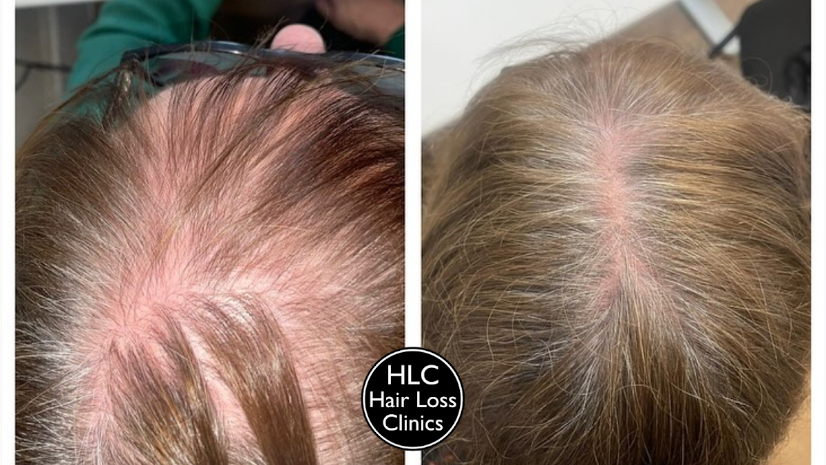Cardiff Hair Loss Clinic - Hair Transplant clinic in Cardiff, United Kingdom