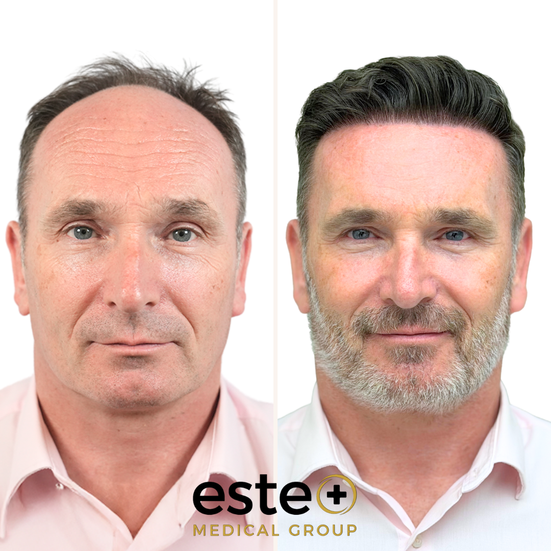 Este Medical Group - Hair Restoration & Skin Clinic Bristol - Hair Transplant clinic in Bristol, United Kingdom