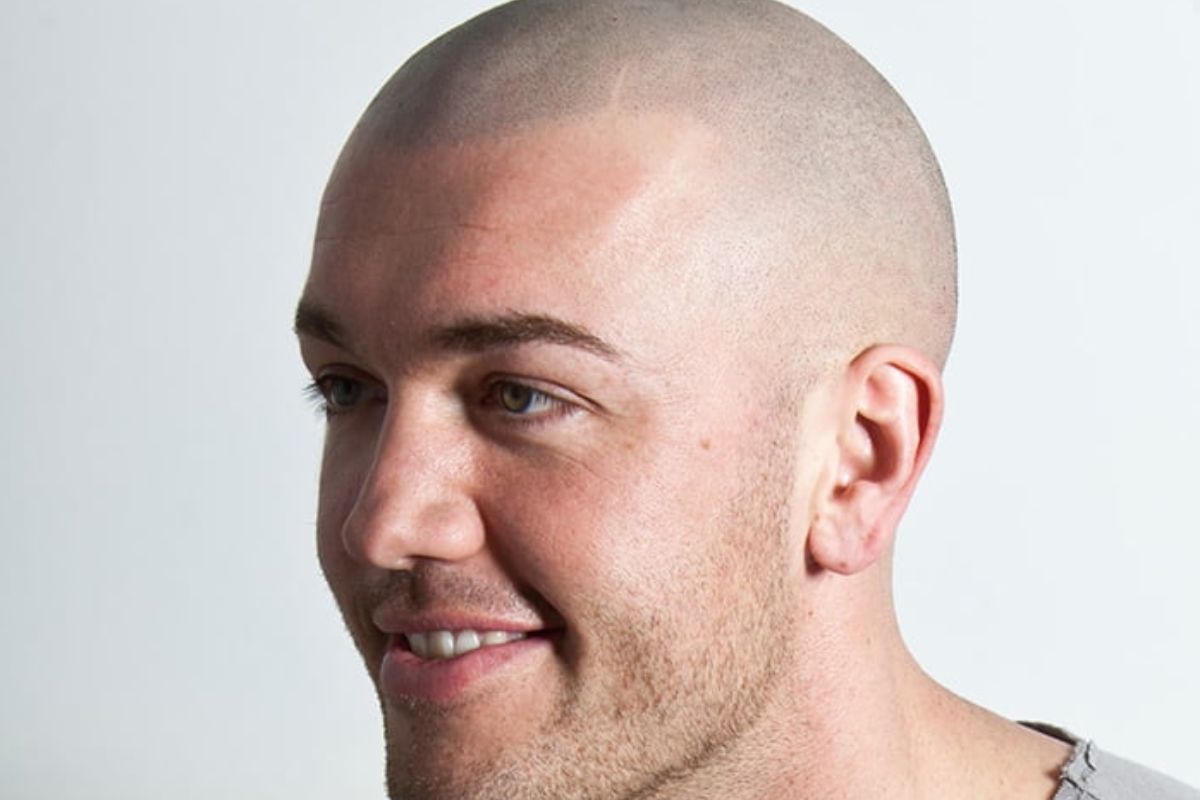 Scalp & Art - Scalp Micropigmentation - Hair Transplant clinic in Nottingham, United Kingdom