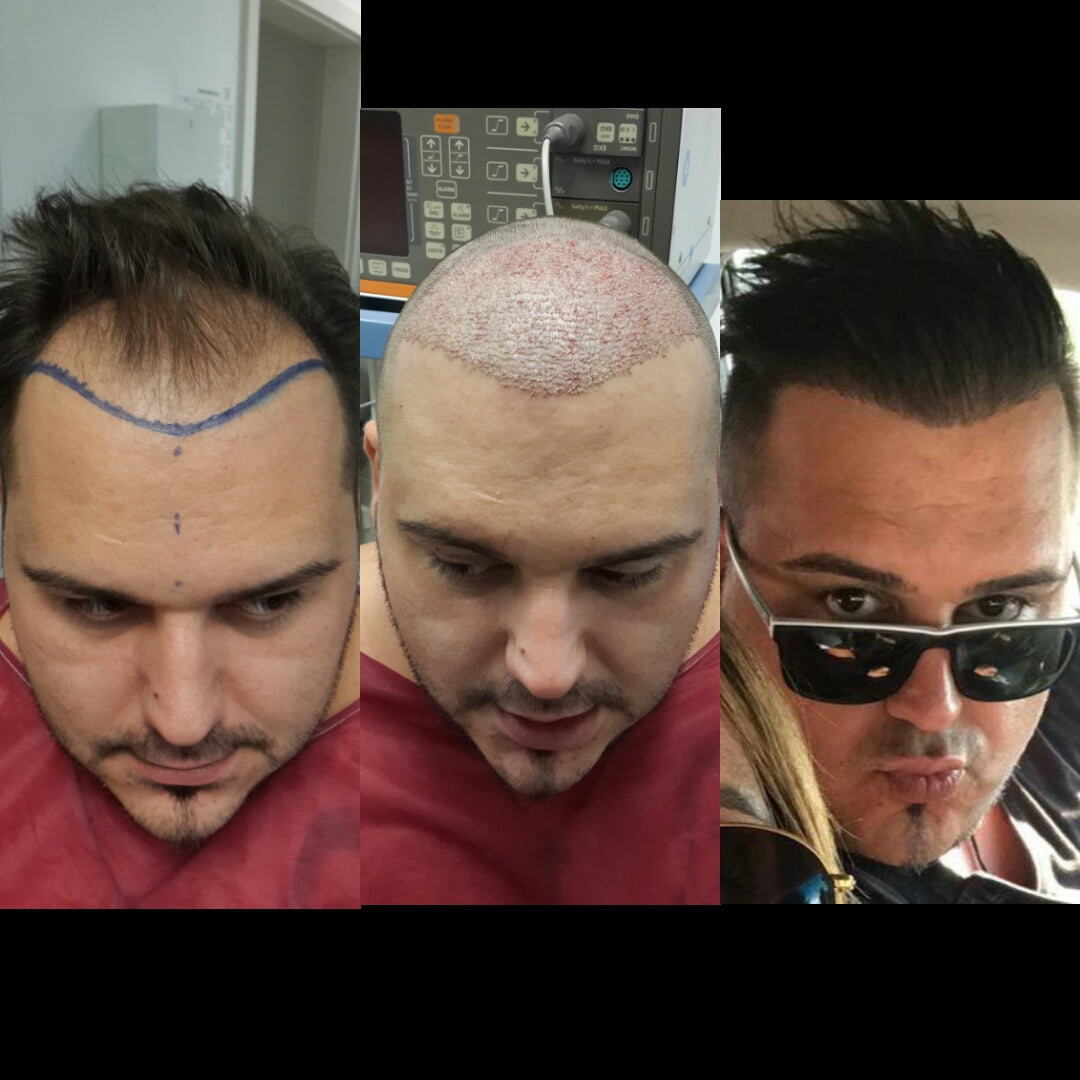 Haartransplantationszentrum - Stuttgart - Hair Transplant clinic in Stuttgart-West, Germany