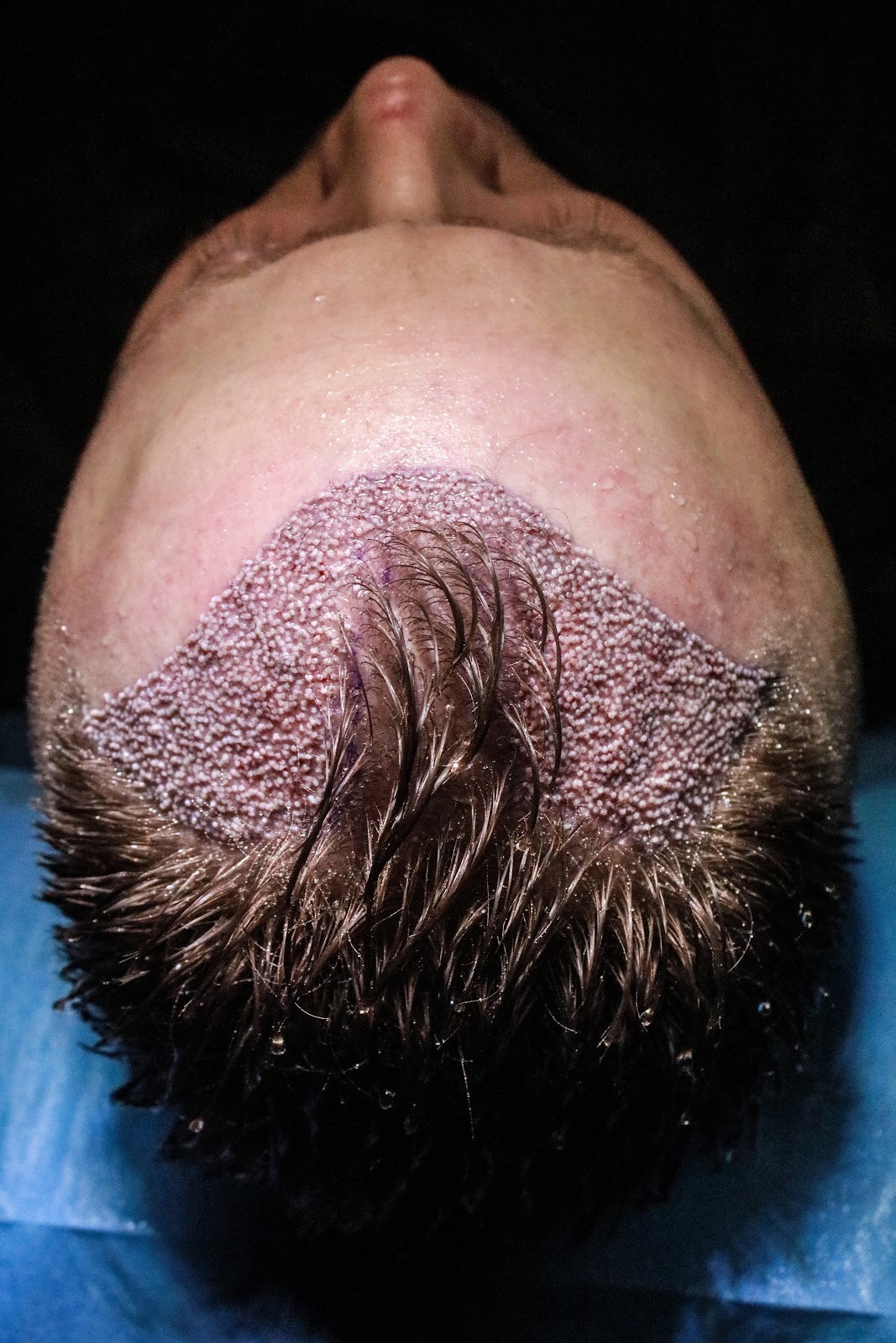 IK Clinics - Hair Transplant clinic in Leicester, United Kingdom
