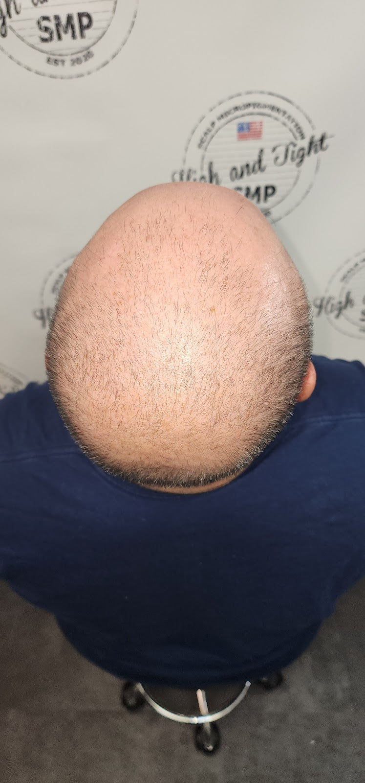 High & Tight SMP- Scalp Micropigmentation | Hair Transplant | Charleston, SC