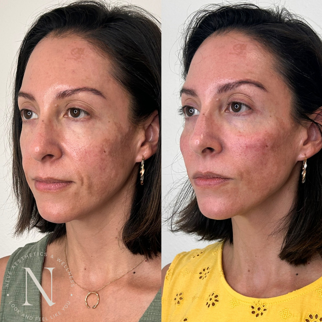 Nevé Aesthetics and Wellness | Aesthetic Surgery | Fort Collins, CO