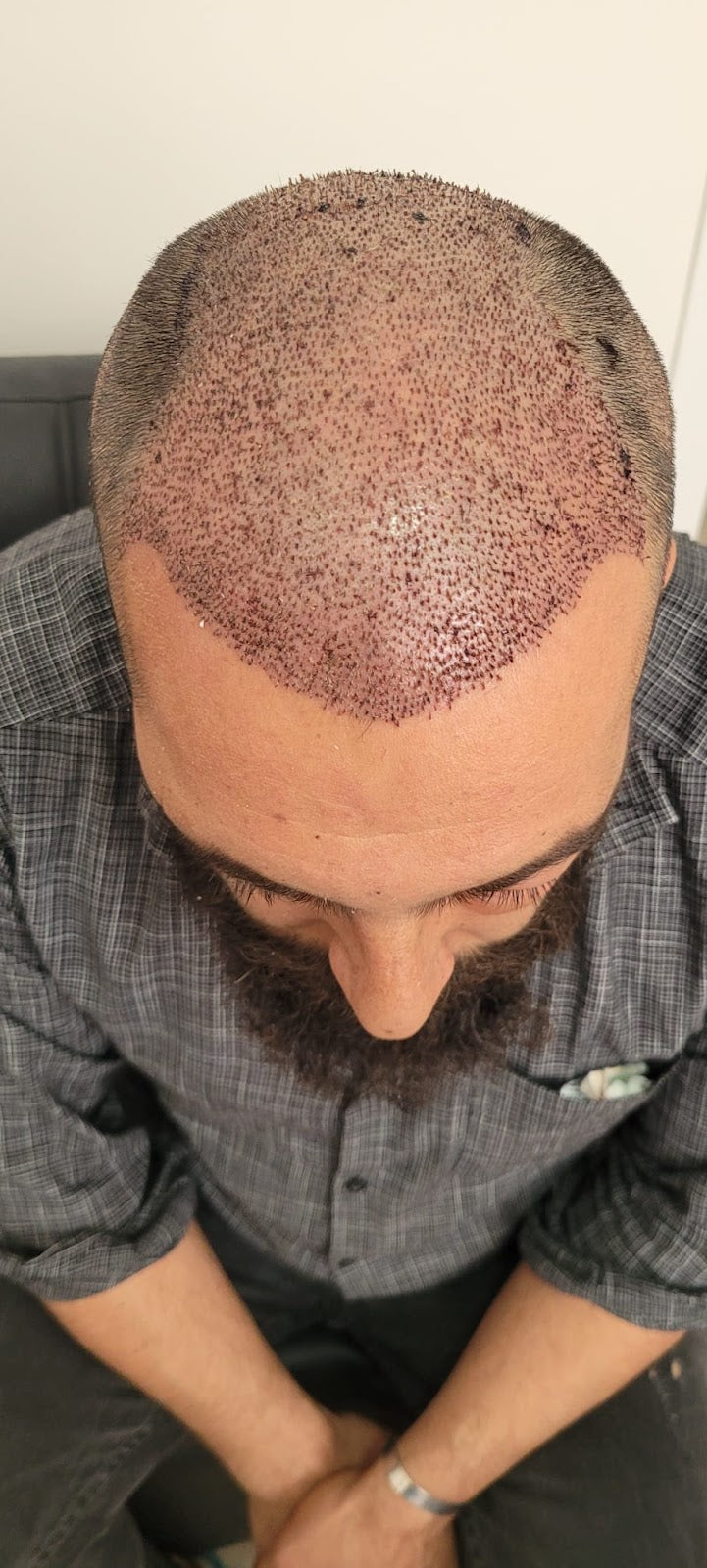 Prp Saç Tedavisi İzmir | Ossi Hair | İzmir Saç Ekimi | Mezoterapi İzmir | PRP İzmir — Dr.Visor photo 5
