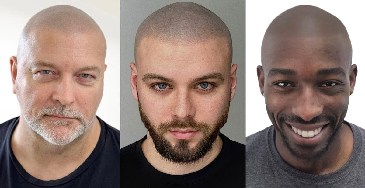 MicroHair™ SMP Scalp Micropigmentation Hair Tattoo Clinic | Liverpool - Hair Transplant clinic in Liverpool, United Kingdom