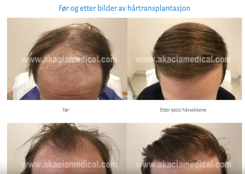 Akacia Medical Norge | Hair Transplant | 1712 Grålum