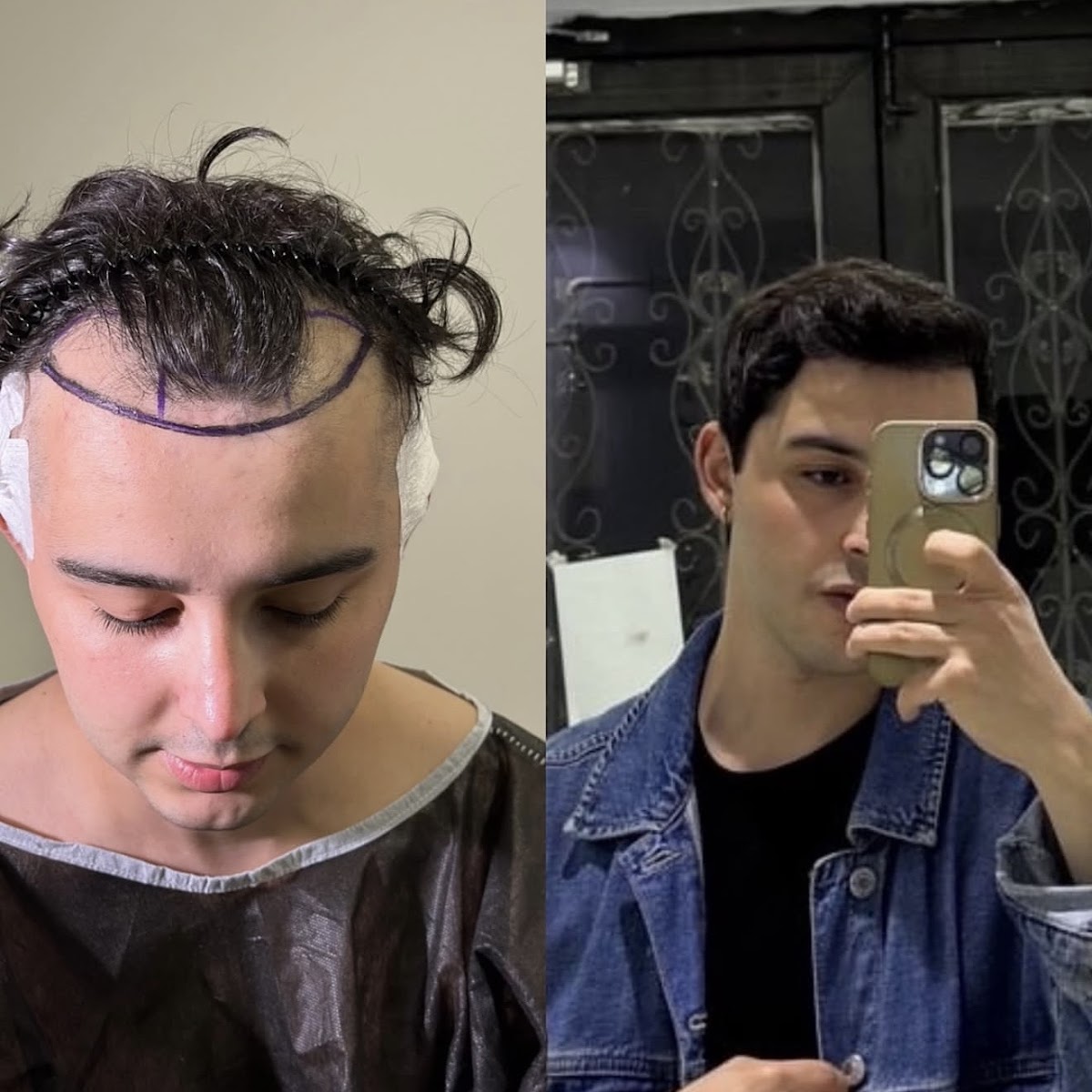 Bozz Clinic | Hair Transplant Albania - Hair Transplant clinic in Tiranë, Albania