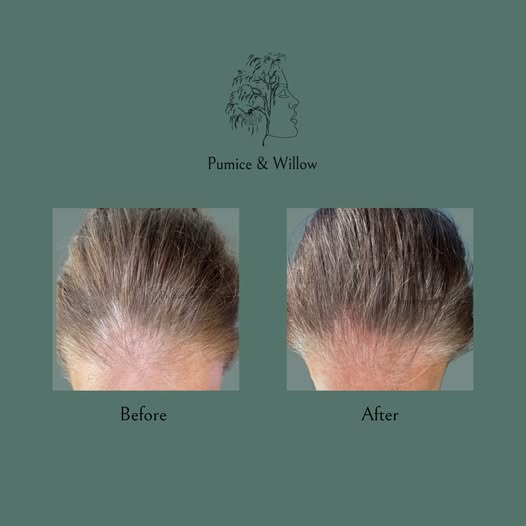Pumice & Willow - Hair Transplant clinic in Liverpool, United Kingdom