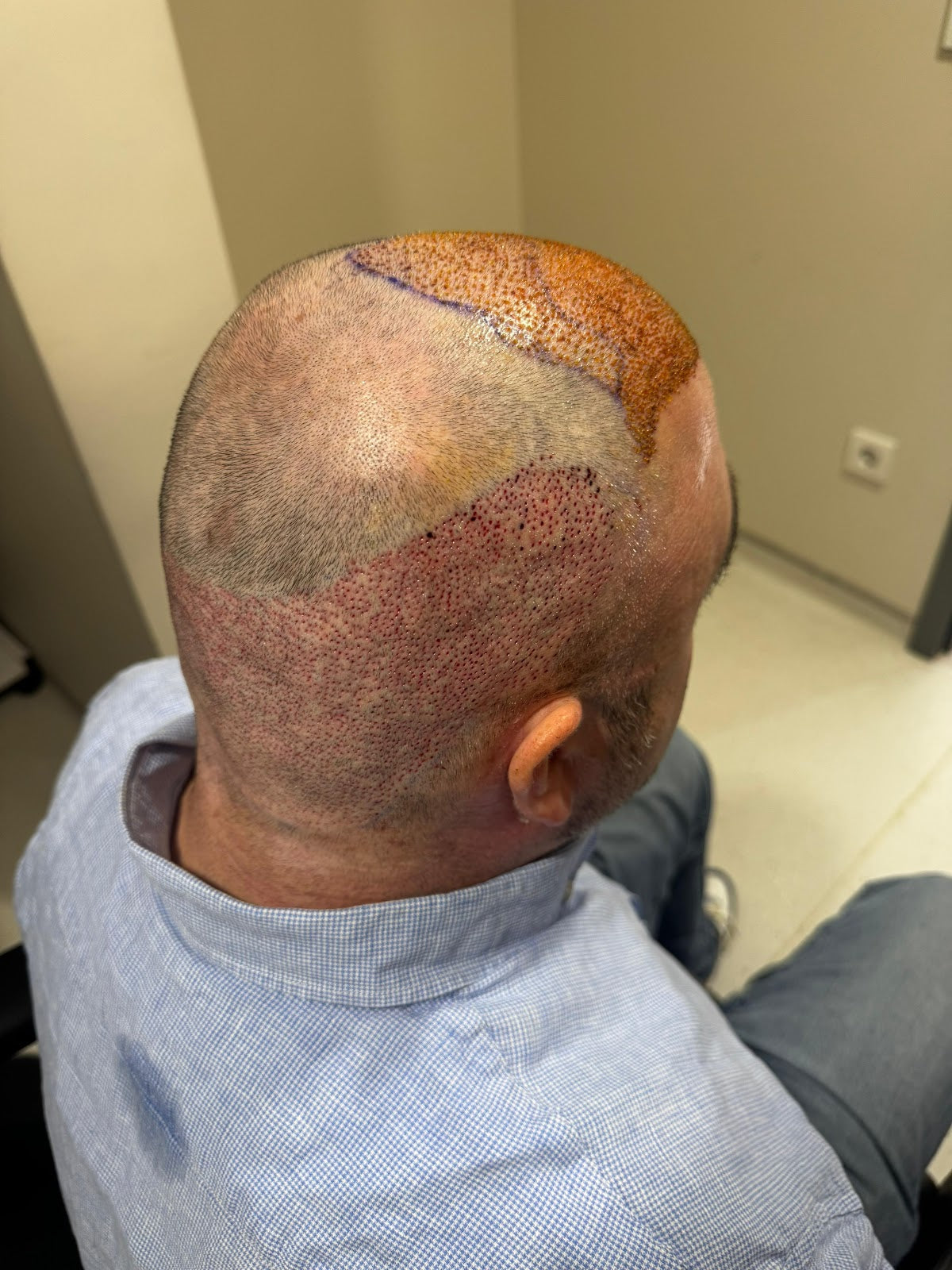 Hermest Hair Clinic | Hair Transplant Turkey Istanbul — Dr.Visor photo 5