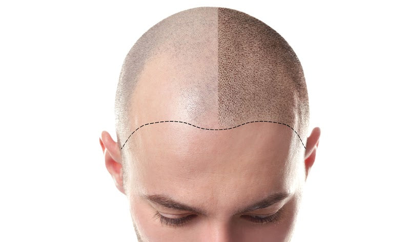 SMPAarhus | Hair Transplant | 8230 Aarhus