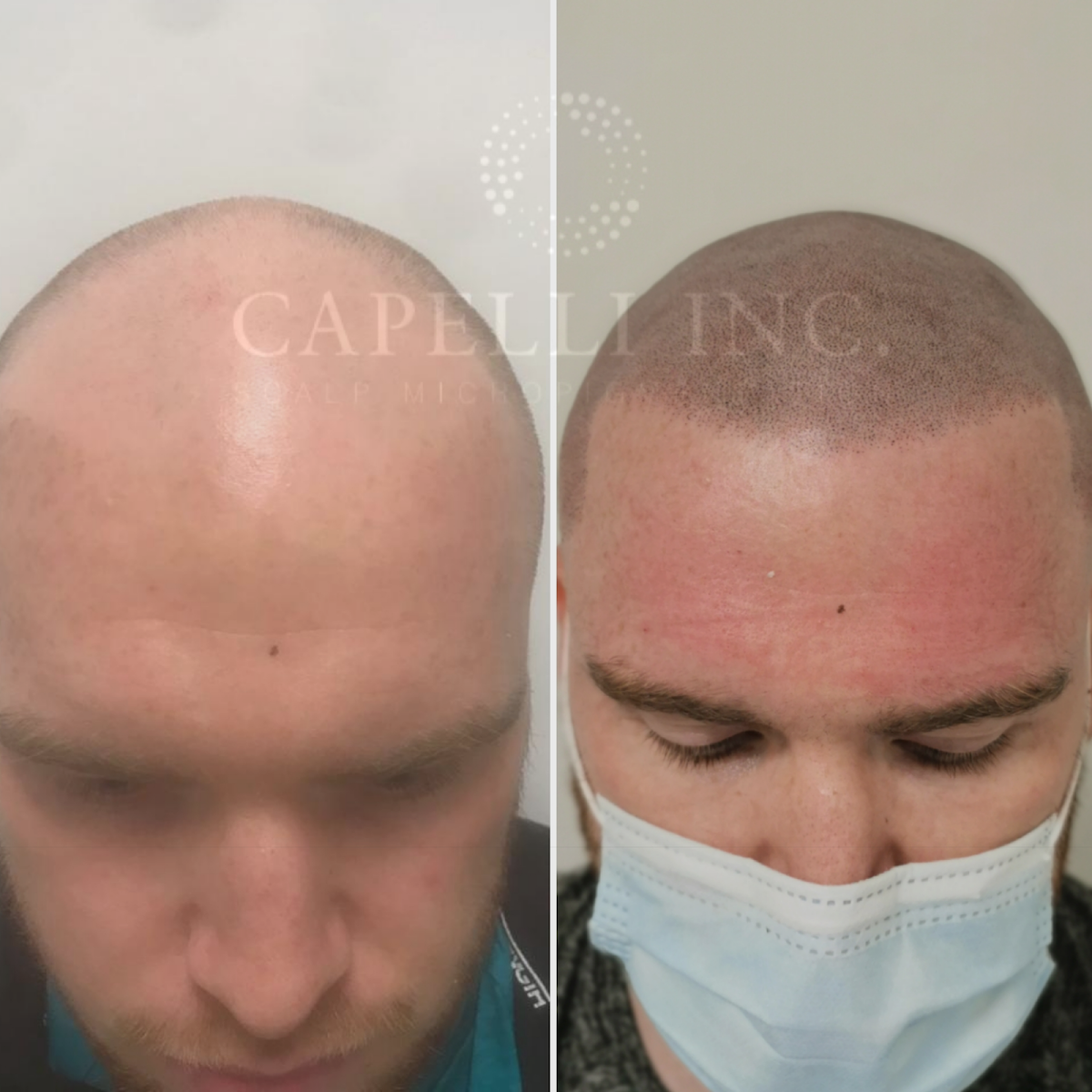 Capelli Inc - Hair Transplant clinic in Liverpool, United Kingdom