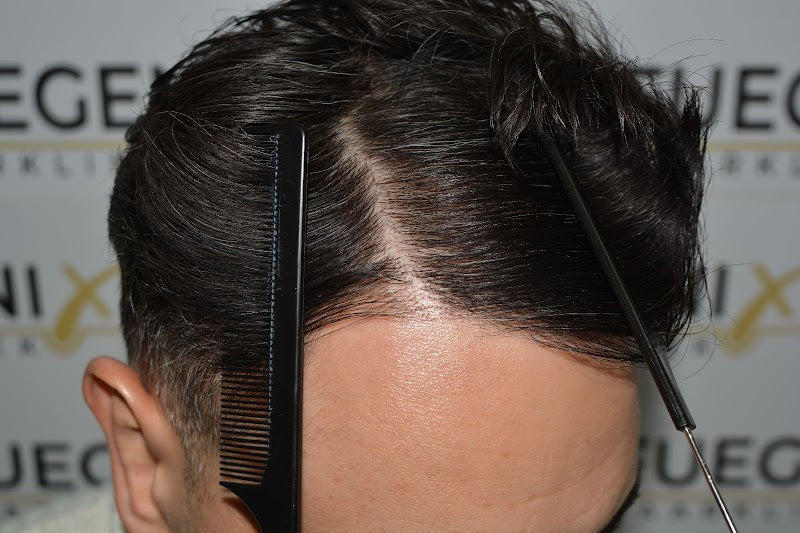 FueGenix Haarkliniek | Haartransplantatie in Nederland | Hair Transplant | 4611 HJ Bergen op Zoom
