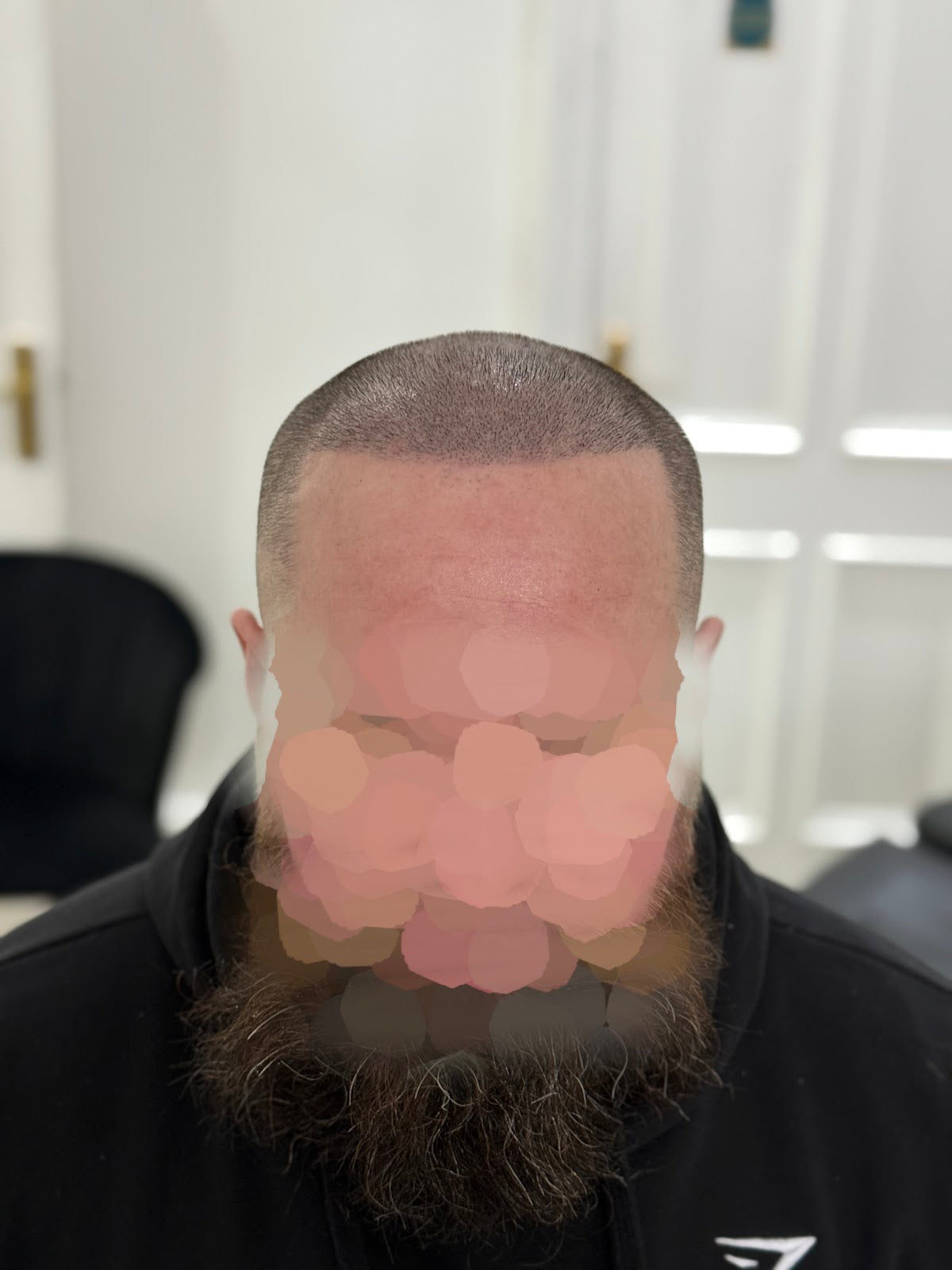 The Scalp Revival Clinic - Hair Transplant clinic in Huddersfield, United Kingdom