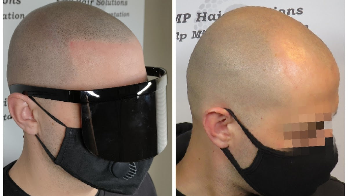 SMP Hair Solutions - Hair Transplant clinic in Leicester, United Kingdom