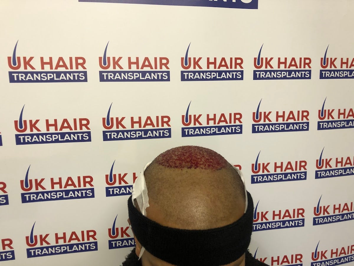 UK Hair Transplants UKHT Walsall — Dr.Visor photo 5