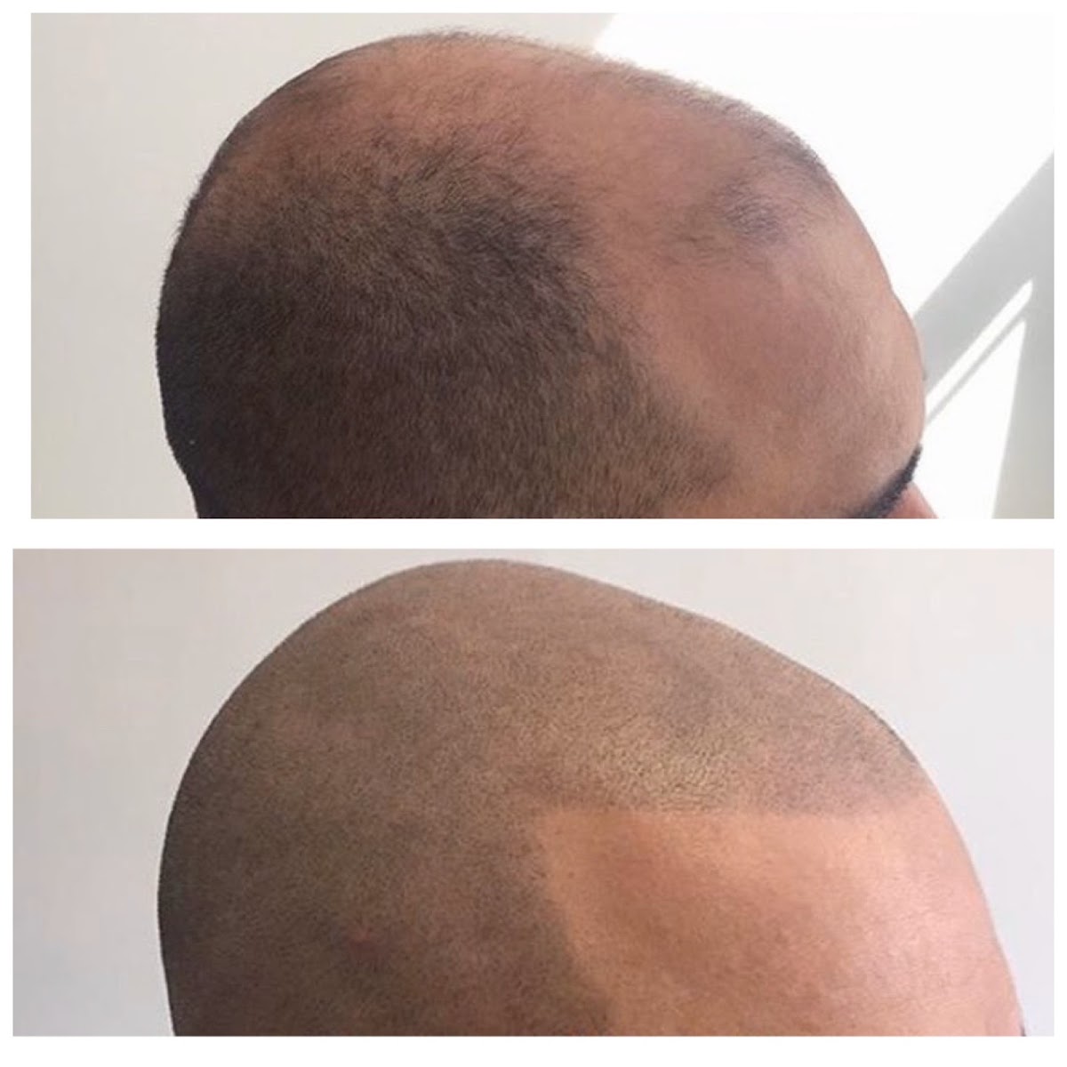 New Image SMP - SMP by JAY - Scalp Micropigmentation | Hair Transplant | Waipahu, HI
