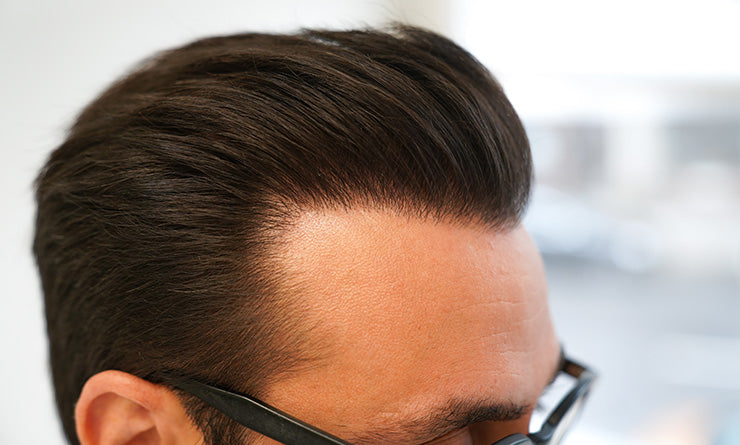 Nordic Hair Clinic Malmö | Hair Transplant | 211 19 Malmö