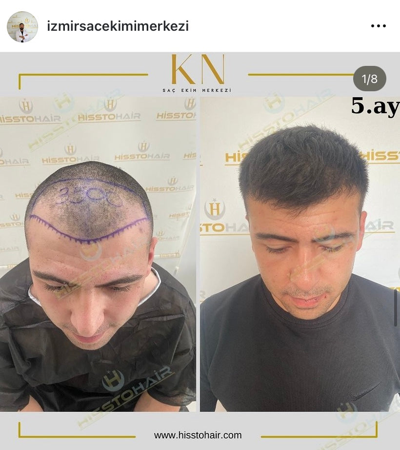 İzmir Saç Ekimi Merkezi - Hisstohair | Fue saç ekimi | PRP ve Mezoterapi | Sakal ekimi | Kaş ekimi — Dr.Visor photo 5
