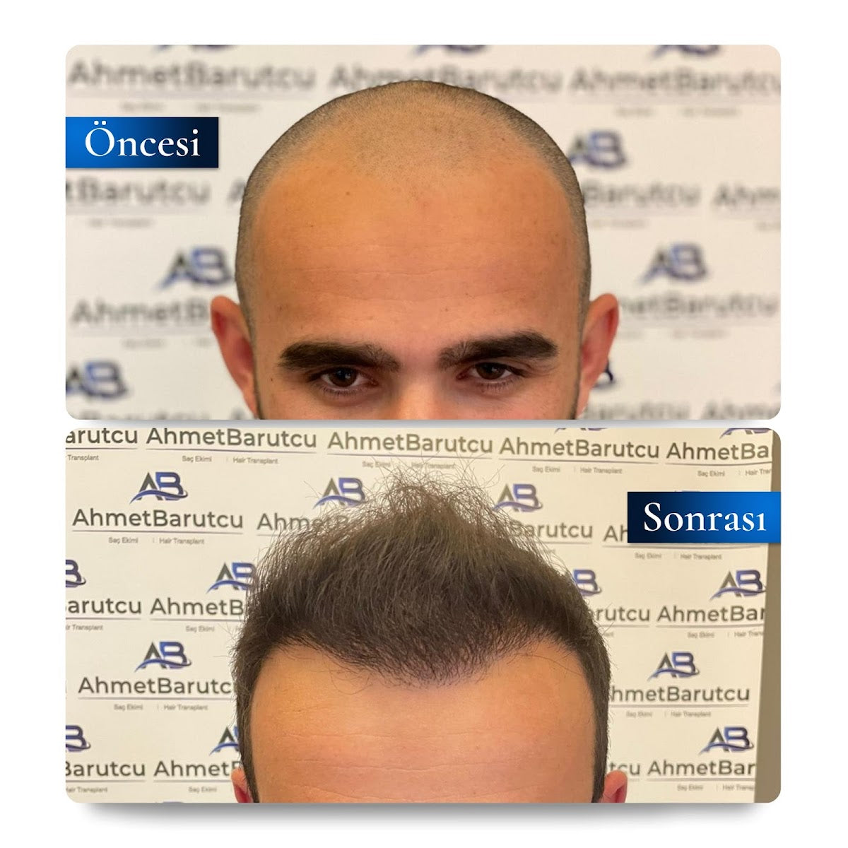 Ahmet Barutcu Saç Ekimi / Hair Transplant — Dr.Visor photo 5