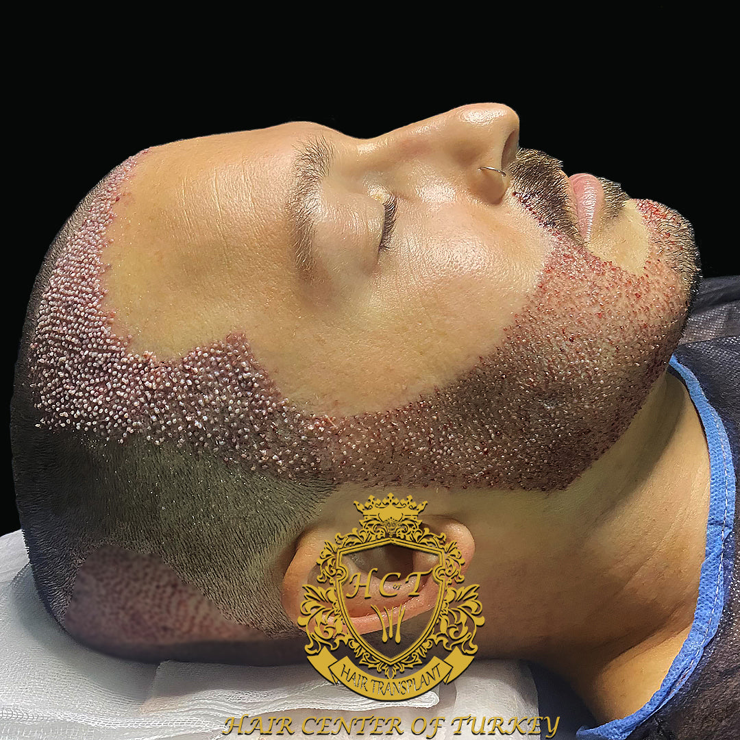 Hair Center Of Turkey - Hair Transplant clinic in Türkiye, Romania