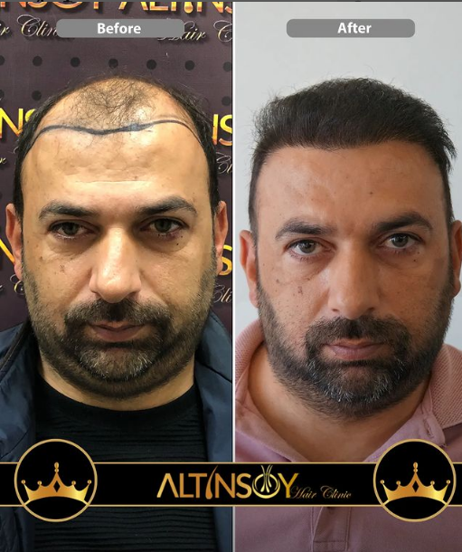 Hair Transplant Of Antalya / Antalya Saç Ekimi / Altınsoy Hair Clinic — Dr.Visor photo 4