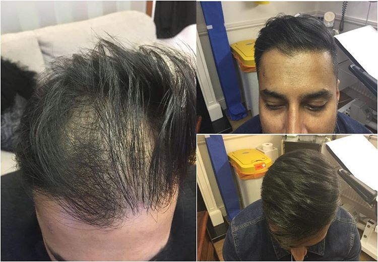 UK Hair Transplant Clinics Leeds — Dr.Visor photo 5