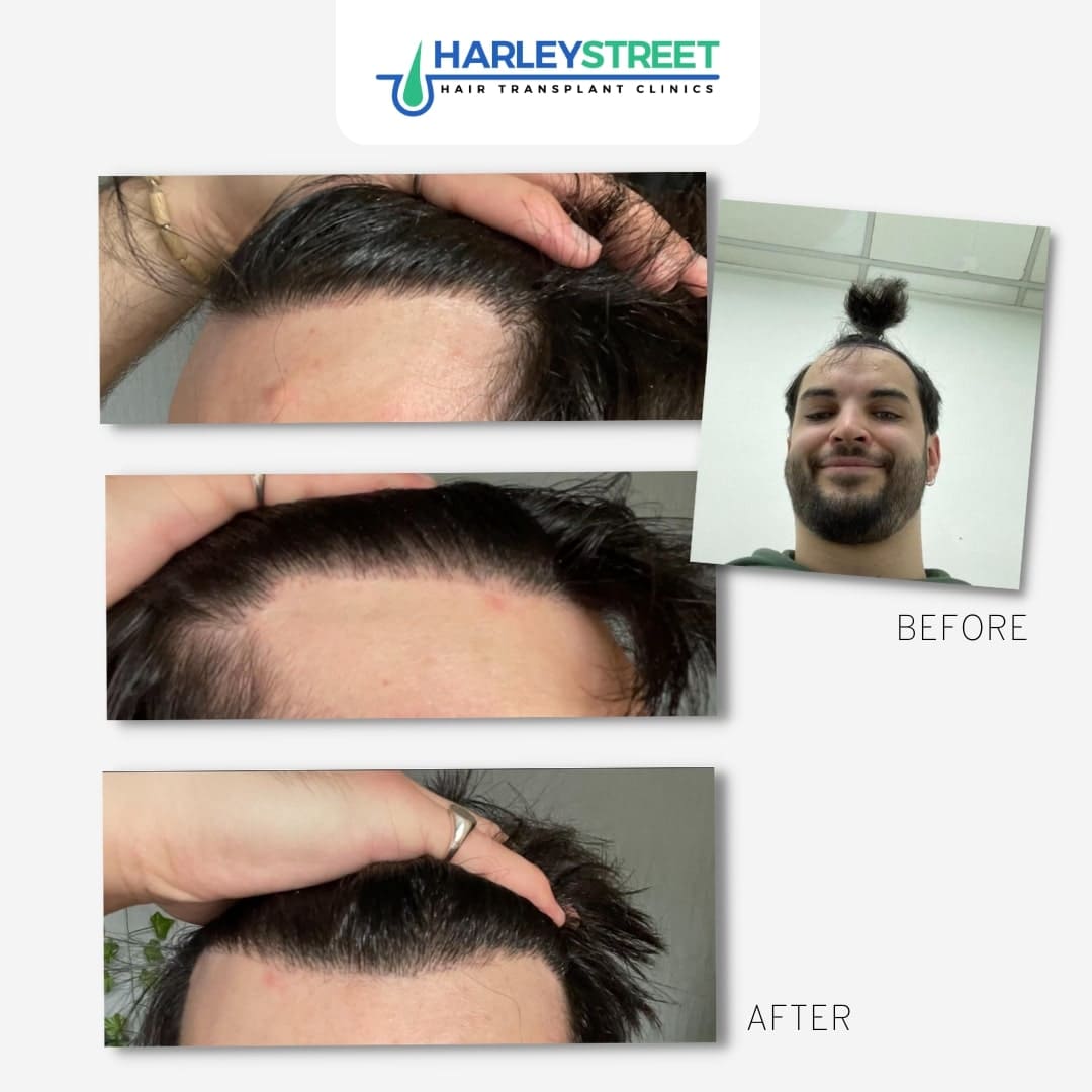 Manchester Hair Transplant Clinic — Dr.Visor photo 5