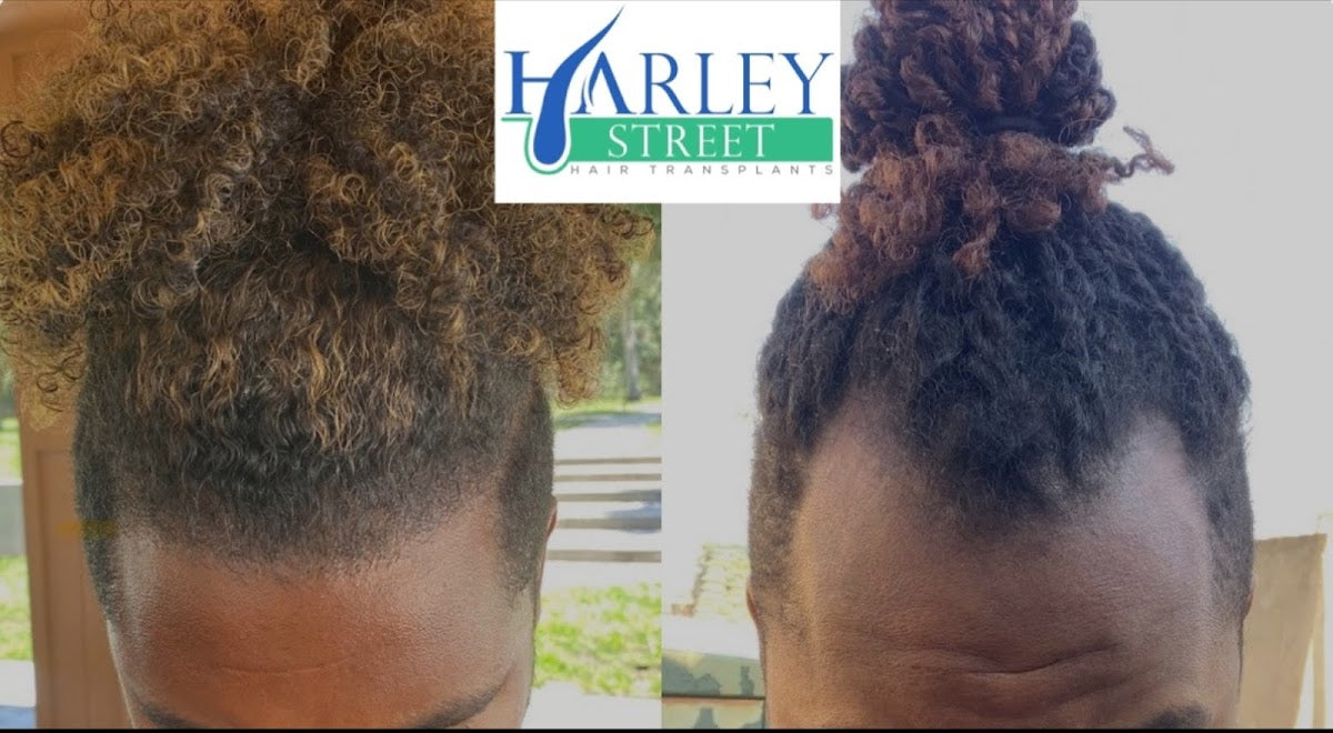 Manchester Hair Transplants Clinics — Dr.Visor photo 5