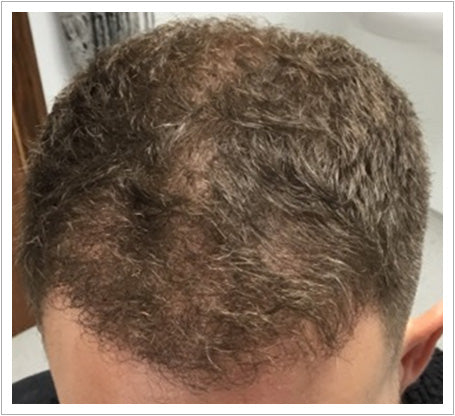 UK Hair Transplant Clinics Birmingham — Dr.Visor photo 5