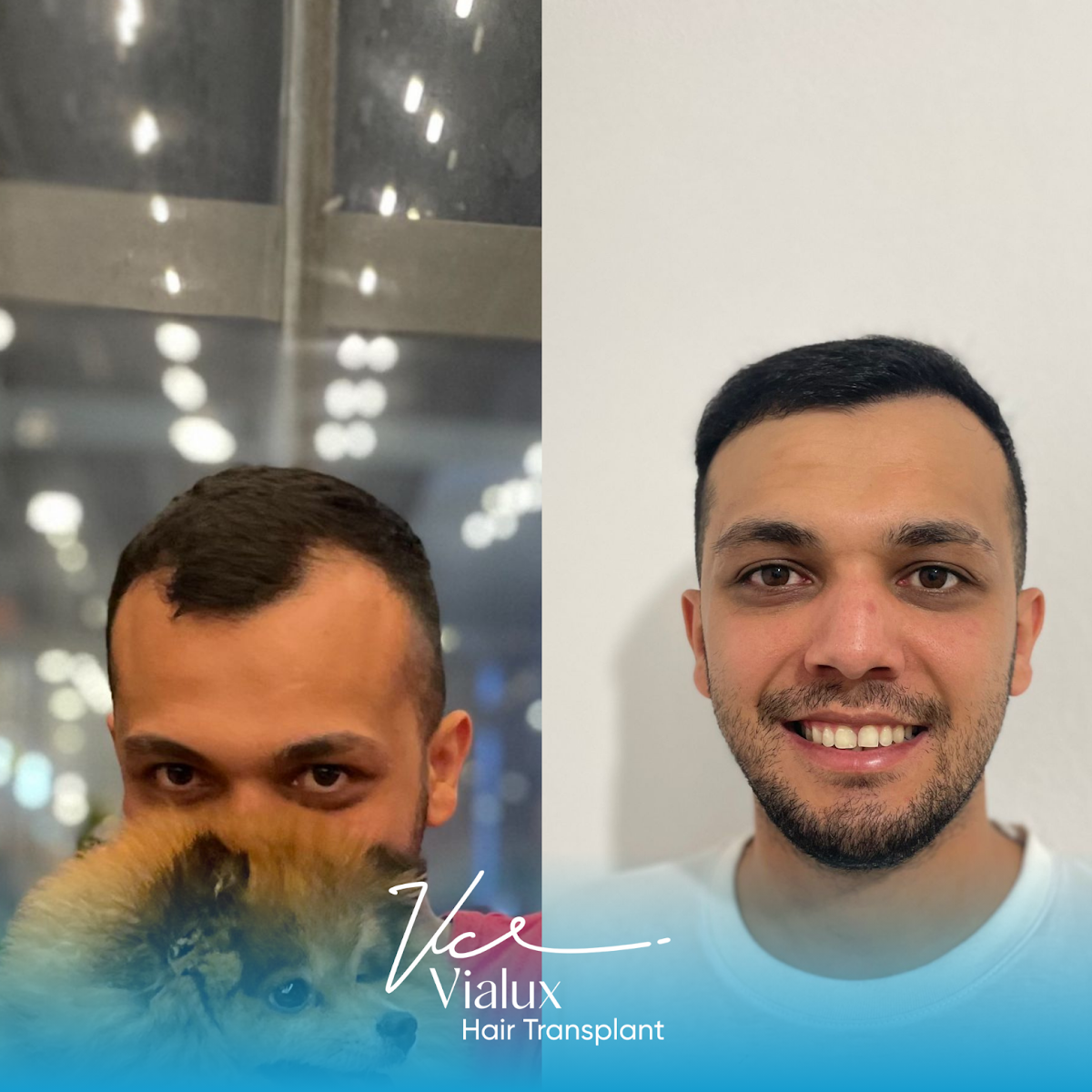 Vialux Hair Transplant | Ankara Saç Ekimi — Dr.Visor photo 5