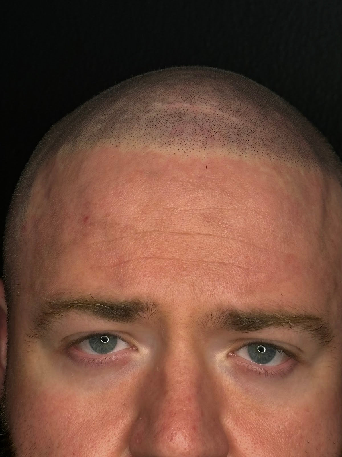 Natural Effect (Scalp Micropigmentation OKC) | Hair Transplant | Oklahoma City, OK