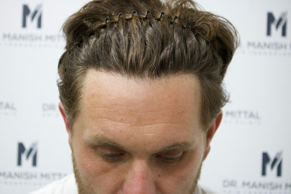 Mittal Hair Clinic | Hair Transplant | London
