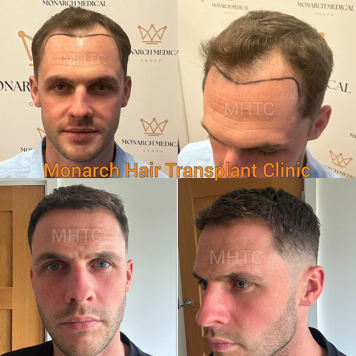 Monarch Hair Transplant Clinic - Hair Transplant clinic in Chester, United Kingdom