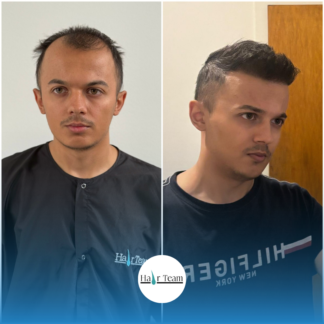 Hair Team Deutschland - Hair Transplant clinic in Köln, Germany