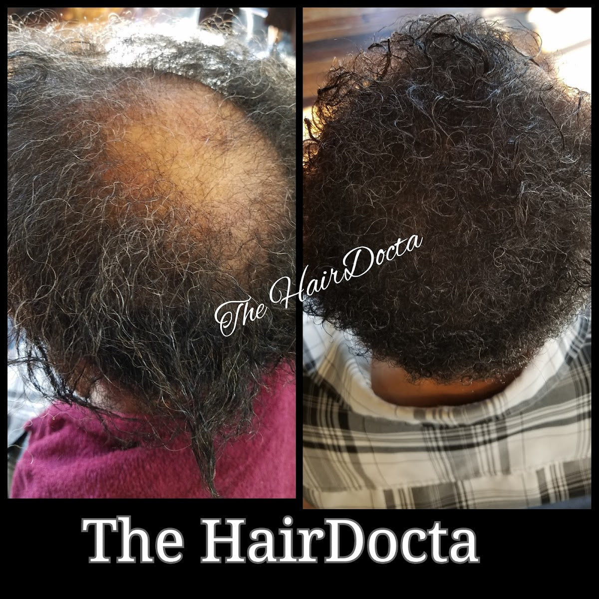 The Hairdocta "Holisitc Hair Loss Specialist" | Hair Transplant | Kansas City, MO