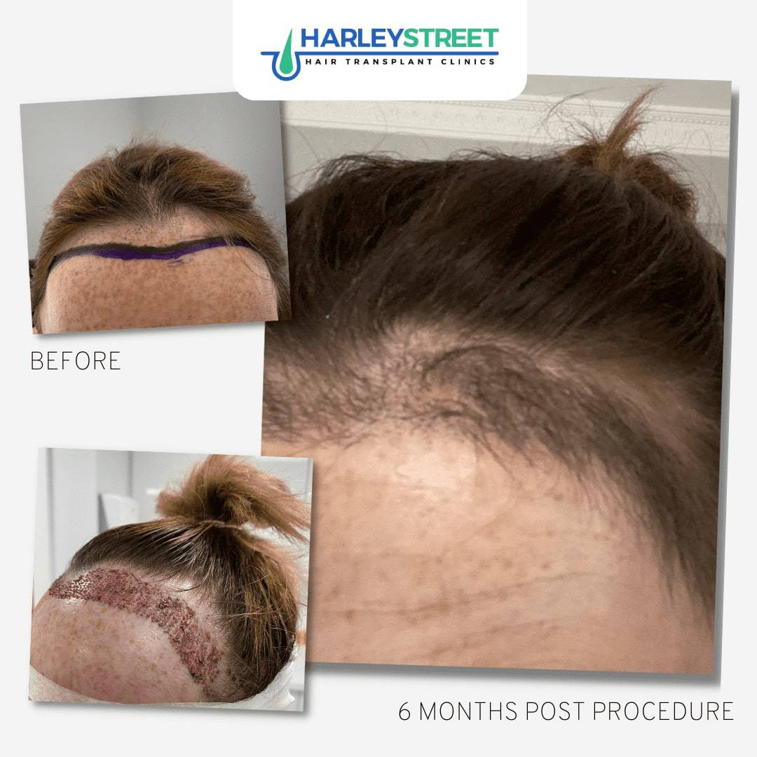 Hair Transplant Leeds — photo 2