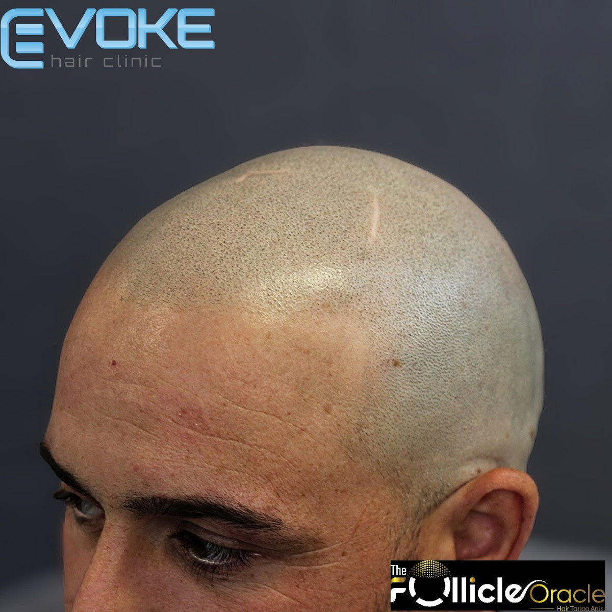 Evoke Hair Clinic (Specialists in Scalp Micropigmentation) - Hair Transplant clinic in Sheffield, United Kingdom