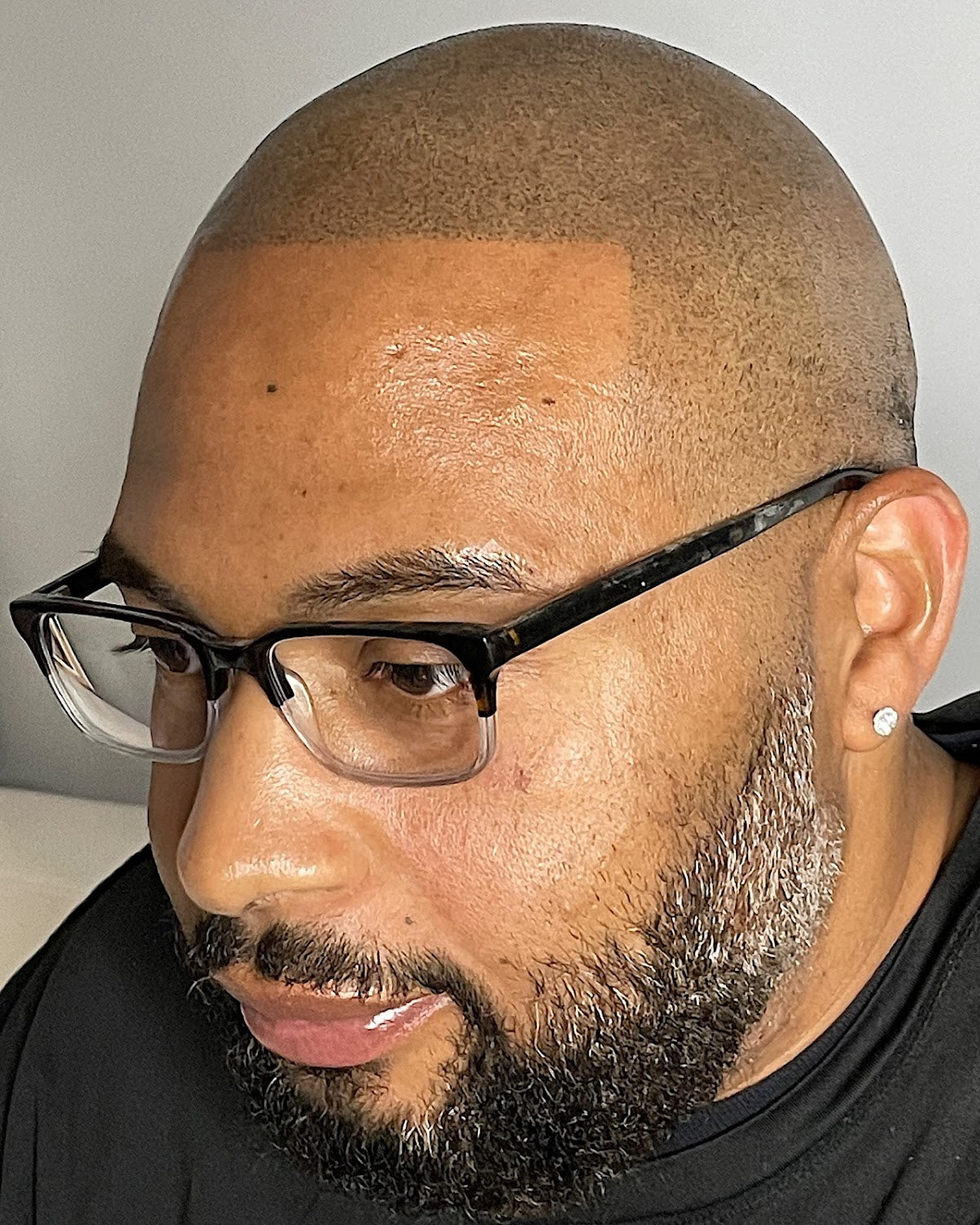 ScalpCarolinas | Hair Transplant | Charlotte, SC