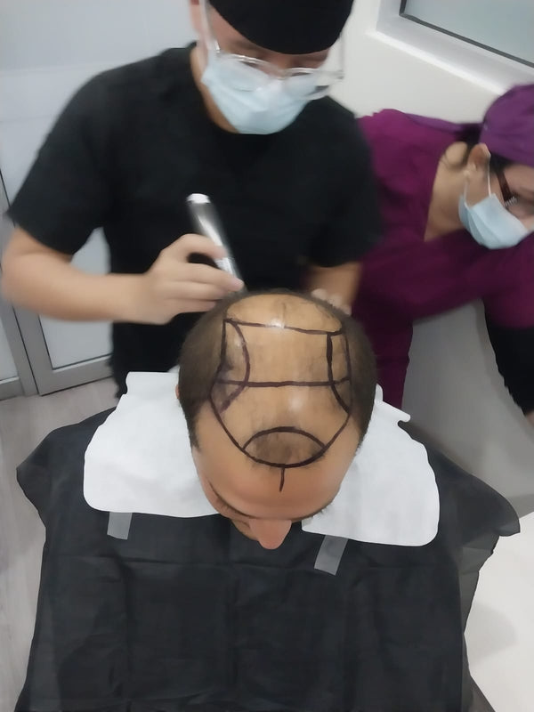 HairMex Hair Transplant Clinic | Hair Transplant | Zona Urbana Rio Tijuana, NM