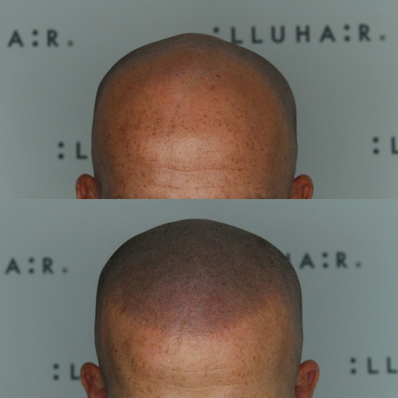 illuhair | Hair Transplant | 6600 Askov