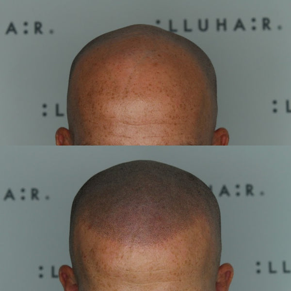 illuhair | Hair Transplant | 6600 Askov