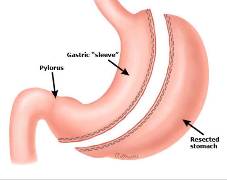 Arch Bariatrics: Kumaran Chinnappan, MD, FACS: Bariatric Weight Loss Surgery | Bariatric Surgery | St. Louis, MO