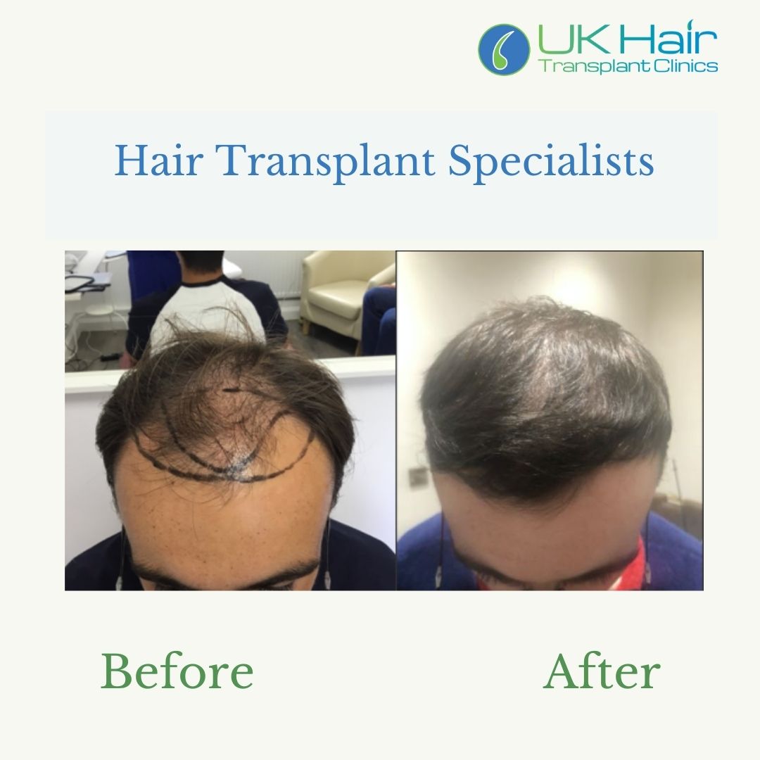 UK Hair Transplant Clinics Manchester — photo 3