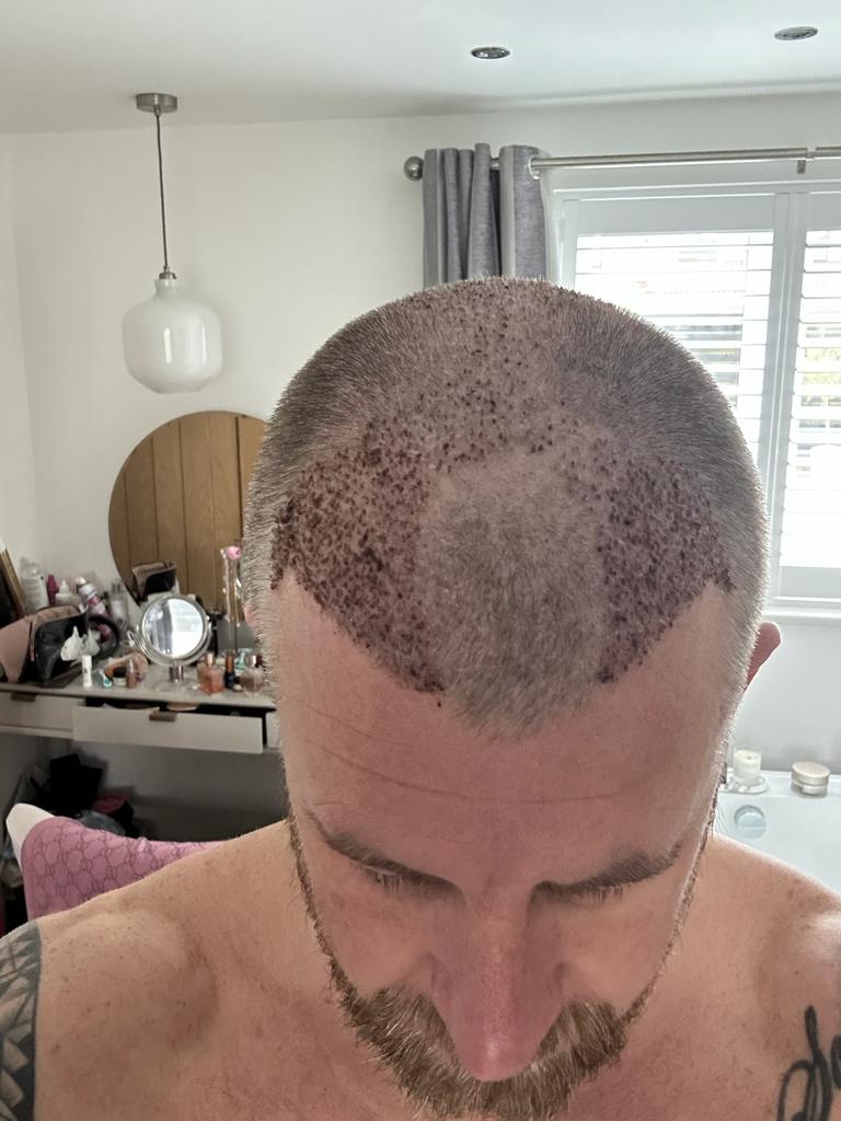 Stoke on Trent Hair Loss Clinic — Hair Transplant Clinic in Newcastle