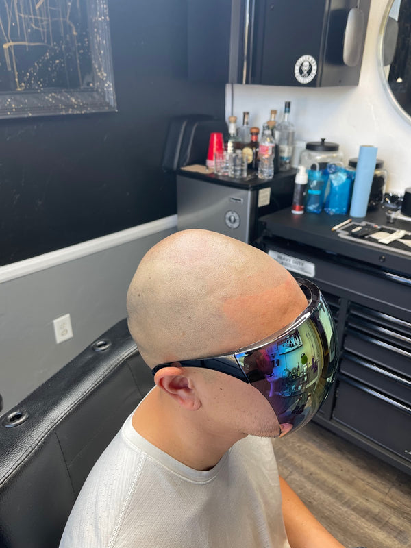 Alpha Male SMP | Hair Transplant | room #115, NV