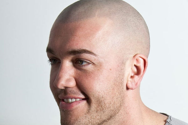 Scalp & Art - Scalp Micropigmentation | Hair Transplant | Nottingham