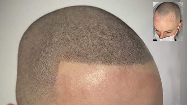 BLACK & WHITE SMP BY DY | Hair Transplant | Bethesda, MD