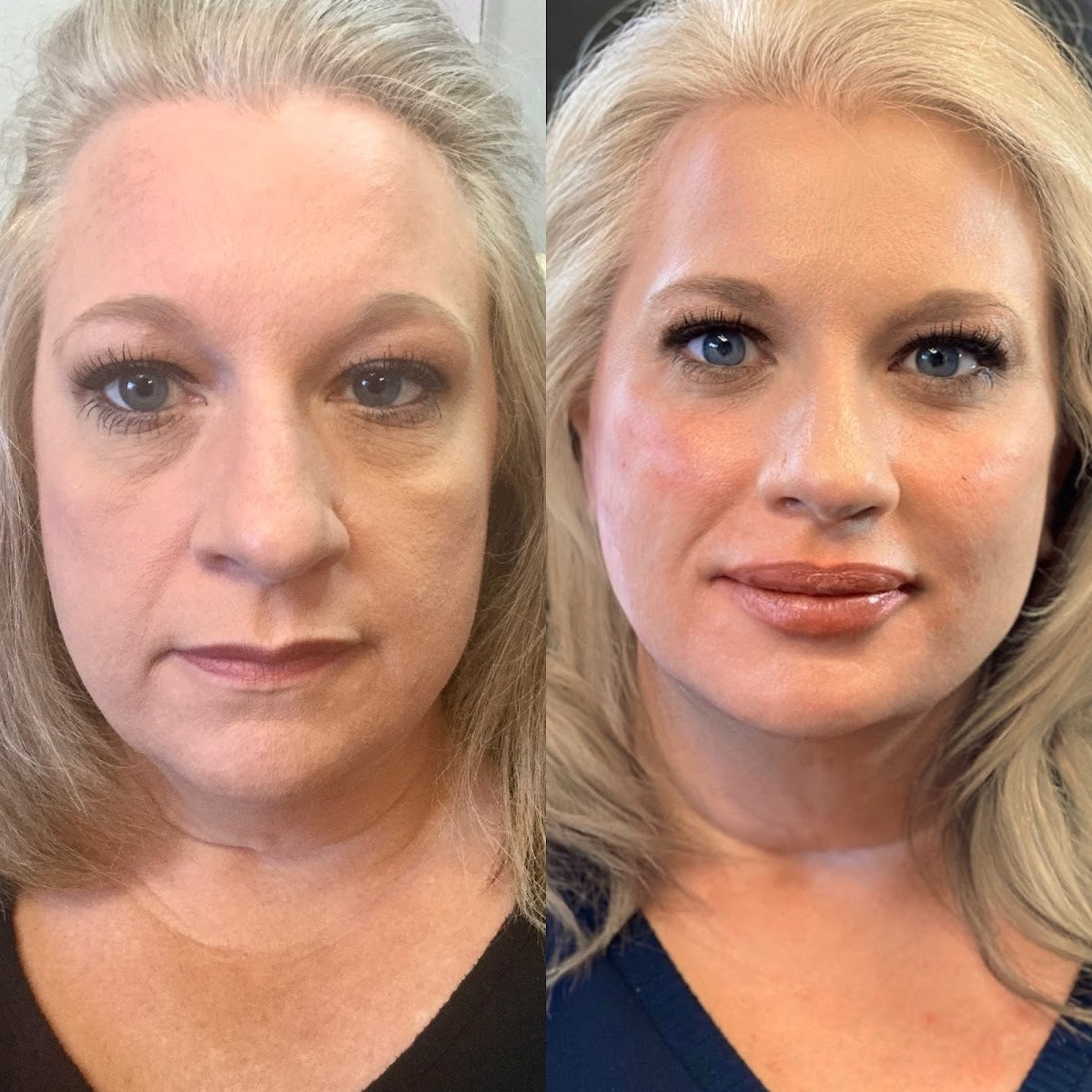 Revenge MD | Hair Transplant | Reno, NV